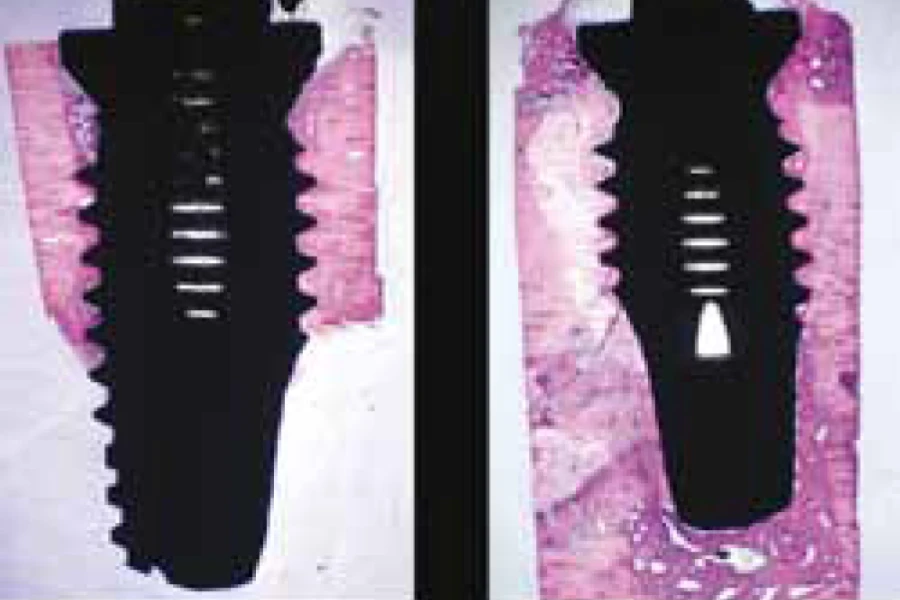 インプラント手術におけるメリット