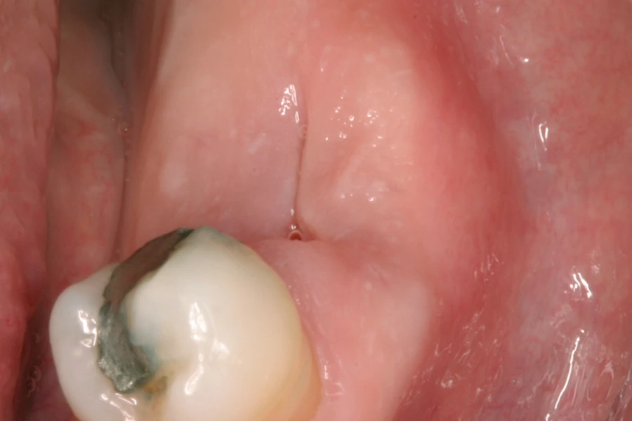 抜歯窩治癒の最適化